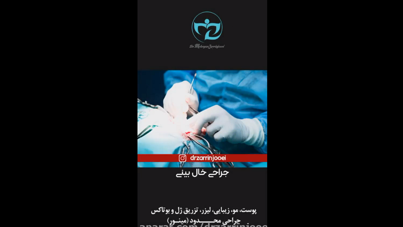 جراحی خال بینی در اصفهان