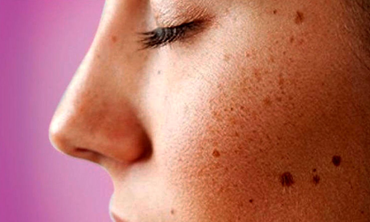 درمان لک های پوستی